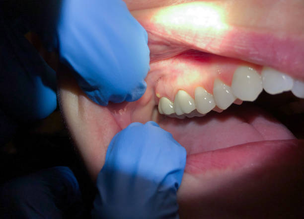 Best Emergency Dentist for Lost Fillings or Crowns in Butte, MT